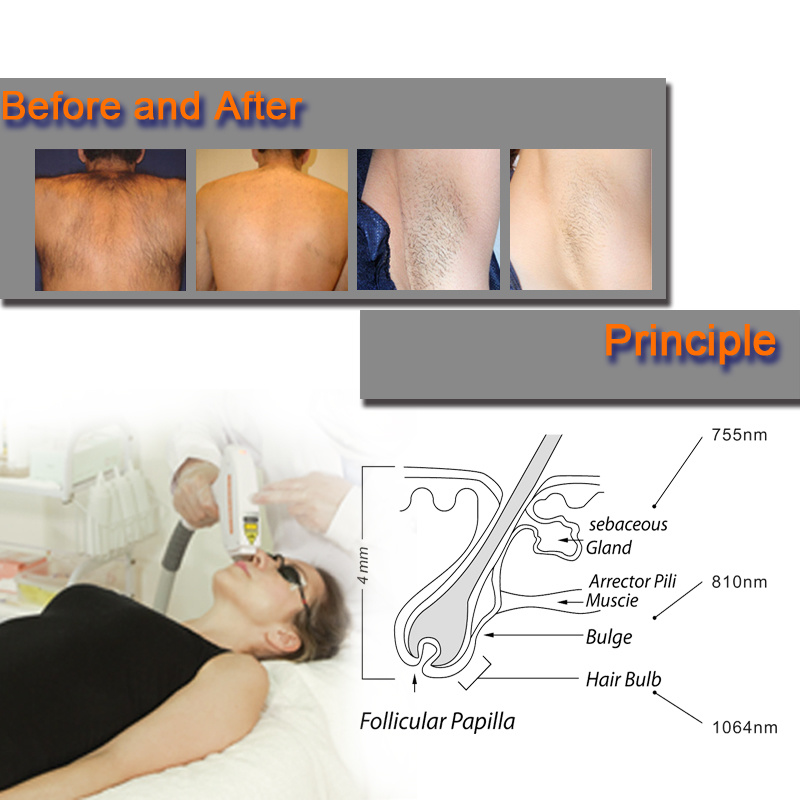 آلة ليزر ديود 8101