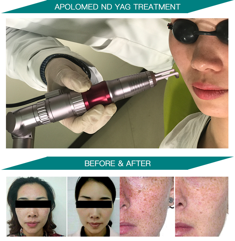 HS-298 قبل وبعد الصورة