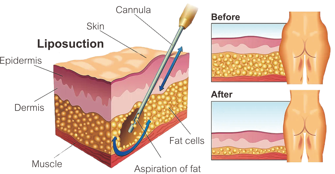 قبضة تحلل الدهون بالليزر 