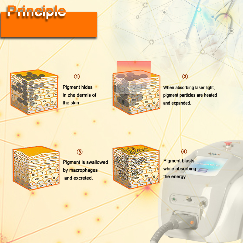 ف التبديل إزالة الوشم 