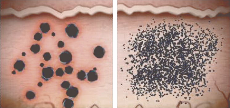 بالليزر التقليدي