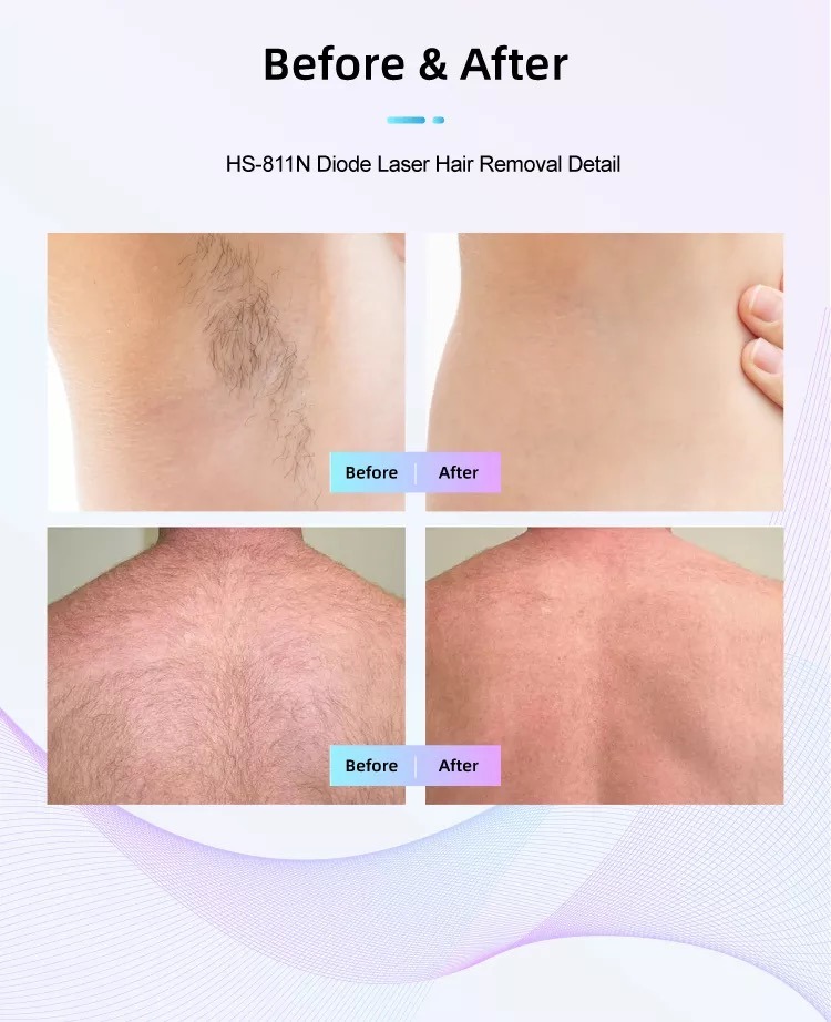مصنع آلة إزالة الشعر بالليزر ديود HS-811