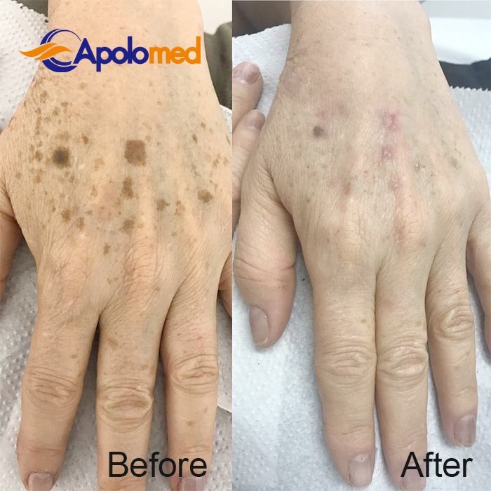 جهاز ليزر Q-Swithced Nd YAG قبل وبعد