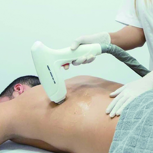 إزالة الشعر