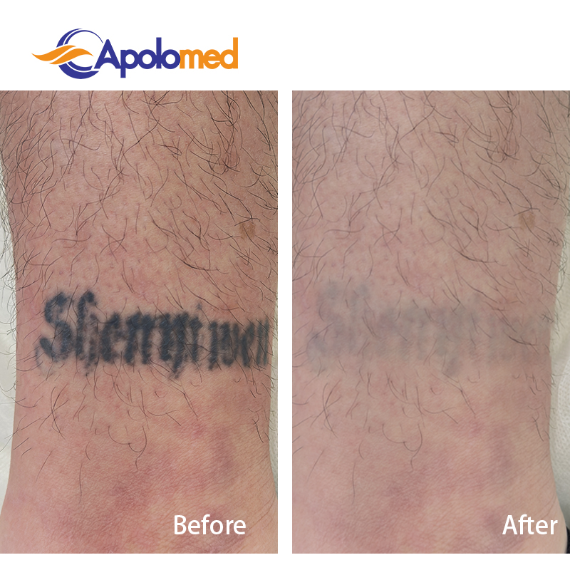 فترة التوقف عن إزالة الوشم بالليزر: ما يمكن توقعه بعد كل جلسة