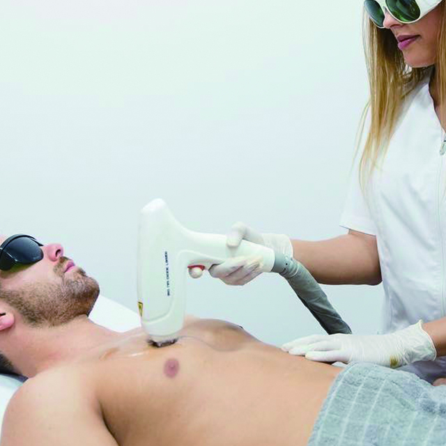 إزالة الشعر ليزر