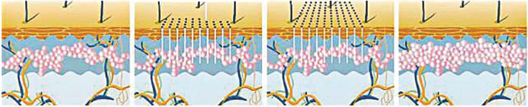 1550 نانومتر ليزر ألياف الإربيوم ---- إعادة البناء العميق